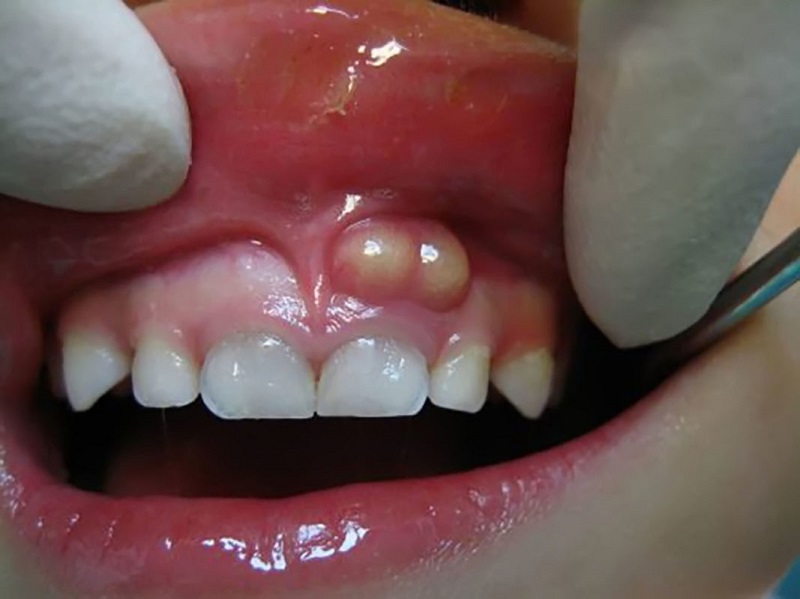 Hình ảnh bệnh nhân bị áp xe quanh chóp răng