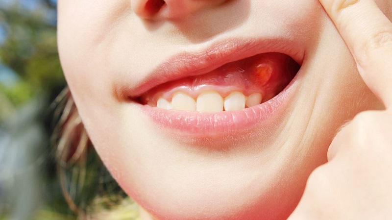 Áp xe quanh chóp răng có thể gây nên nhiều biến chứng khác nhau