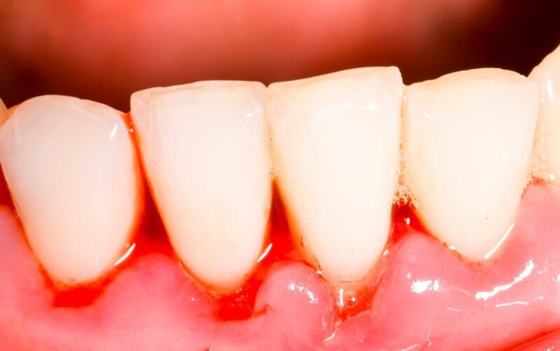Áp xe răng là tình trạng viêm nhiễm xung quanh chân răng ở mức độ nặng do vi khuẩn gây ra