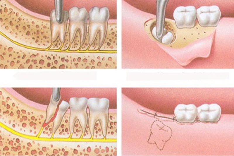 Thực hiện nhổ bỏ răng khôn đặc biệt là răng bị áp xe mọc nghiêng, lệch.