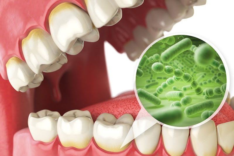 Vi khuẩn là nguyên nhân chính gây ra chứng áp xe răng ở trẻ nhỏ