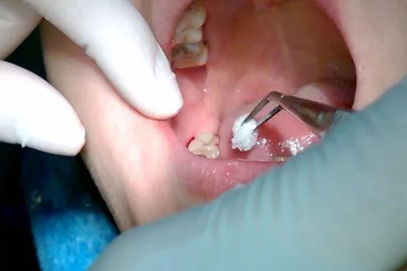 Điều trị áp xe răng số 7 nên thực hiện tại cơ sở nha khoa uy tín.