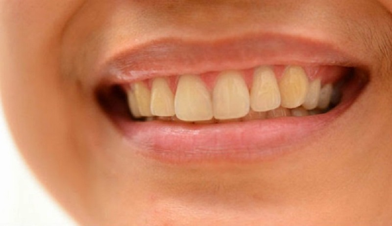 Việc áp dụng các bài thuốc chữa đau răng có thể làm vàng răng trong một thời gian 
