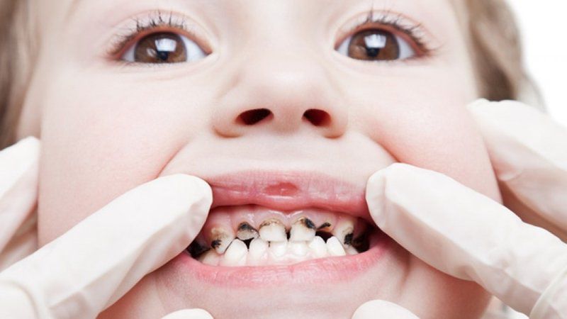 Trong trường hợp sâu răng nặng trẻ có thể bị viêm tủy
