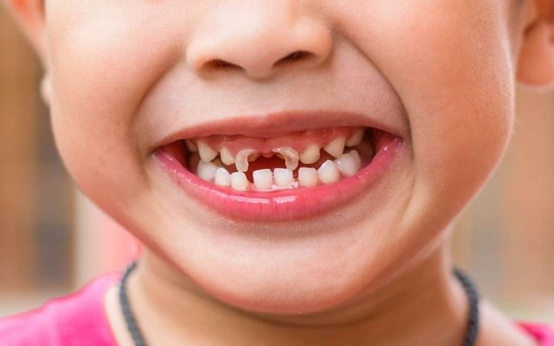 Trẻ 4 tuổi bị sâu răng là hiện tượng rất phổ biến