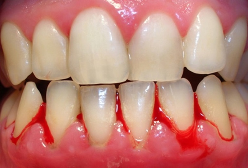 Tình trạng này có diễn biến thầm lặng và khá phức tạp, gây ra những nguy hiểm đến sức khỏe răng miệng