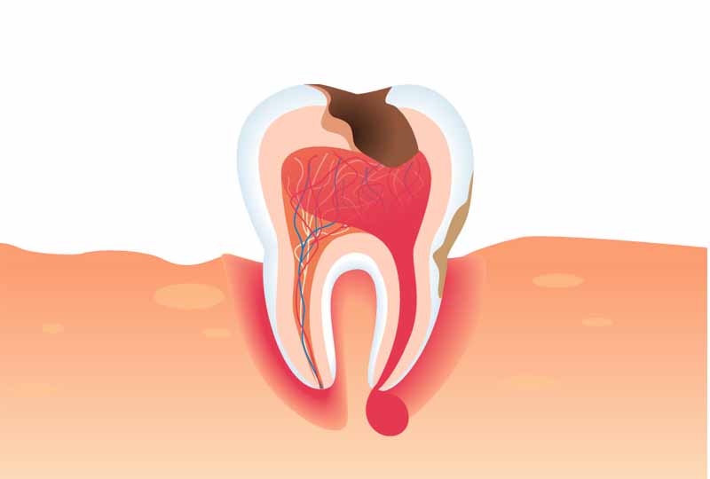 Áp xe răng là bệnh lý nguy hiểm gây ảnh hưởng đến sức khỏe chúng ta 