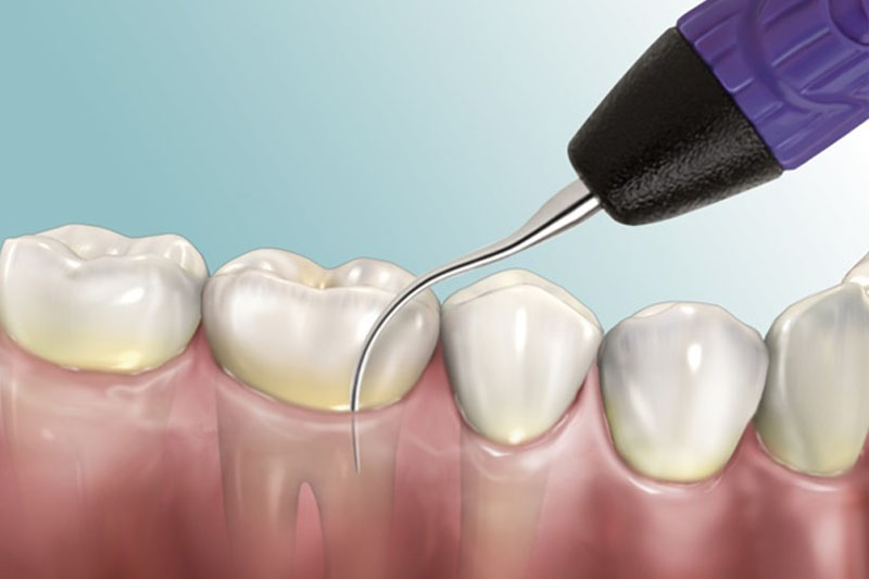 Việc thực hiện đến nha khoa để lấy cao răng là điều cần thiết
