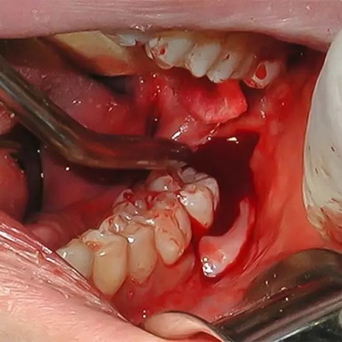 Chảy máu kéo dài sau khi nhổ răng khôn có thể dẫn đến tử vong 