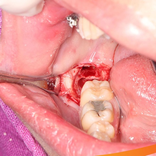 Nhiễm trùng huyệt ổ răng là biến chứng nguy hiểm bạn cần cảnh giác 