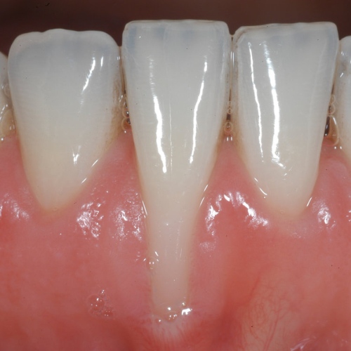 Tình trạng tụt lợi do bác sĩ bọc răng sai kỹ thuật 