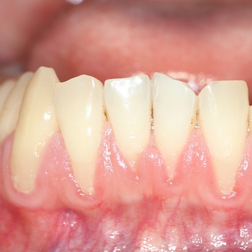 Bọc răng sứ bị tụt lợi xảy ra do chất liệu sứ kém chất lượng 