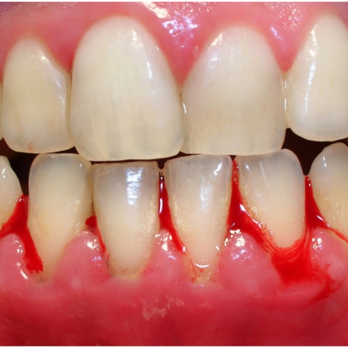 Nha sĩ không điều trị bệnh lý răng miệng dẫn đến tut nướu sau khi bọc sứ