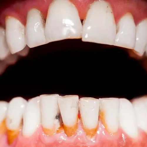 Bọc răng sứ bị tụt lợi gây mất thẩm mỹ và tăng nguy cơ mắc bệnh lý nha khoa