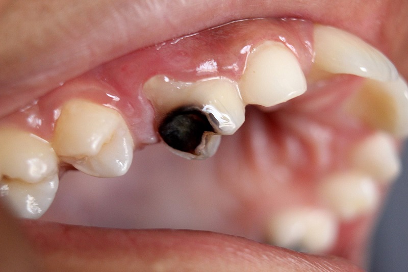 Bé 5 tuổi bị sâu răng là tình trạng phổ biến khiến nhiều cha mẹ lo lắng.