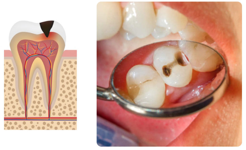 Những lỗ sâu phát triển bắt đầu ăn vào tủy răng.