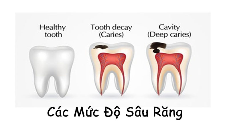 Biểu hiện của các cấp độ sâu răng 