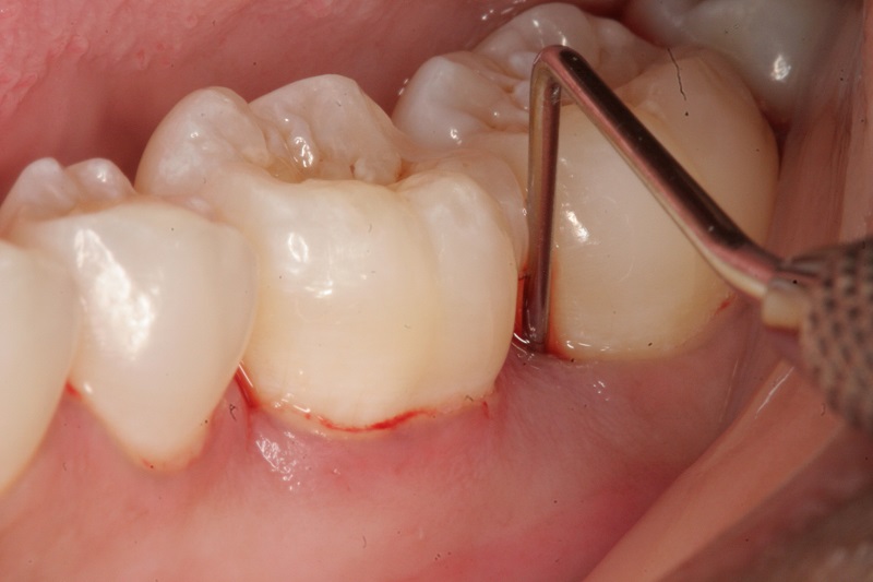 Hướng dẫn điều trị sưng nướu răng có mủ