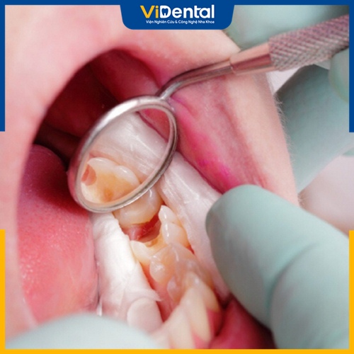 Vệ sinh răng miệng không tốt là một trong những nguyên nhân gây viêm tủy răng