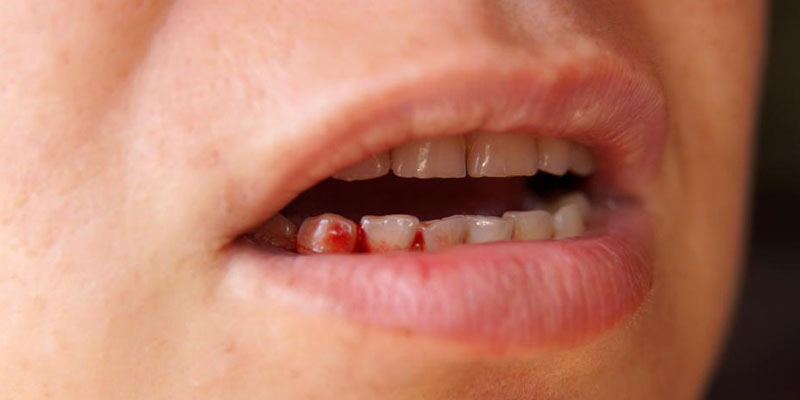 Hôi miệng và chảy máu chân răng dễ gây ra những biến chứng nguy hiểm nếu không điều trị đúng cách