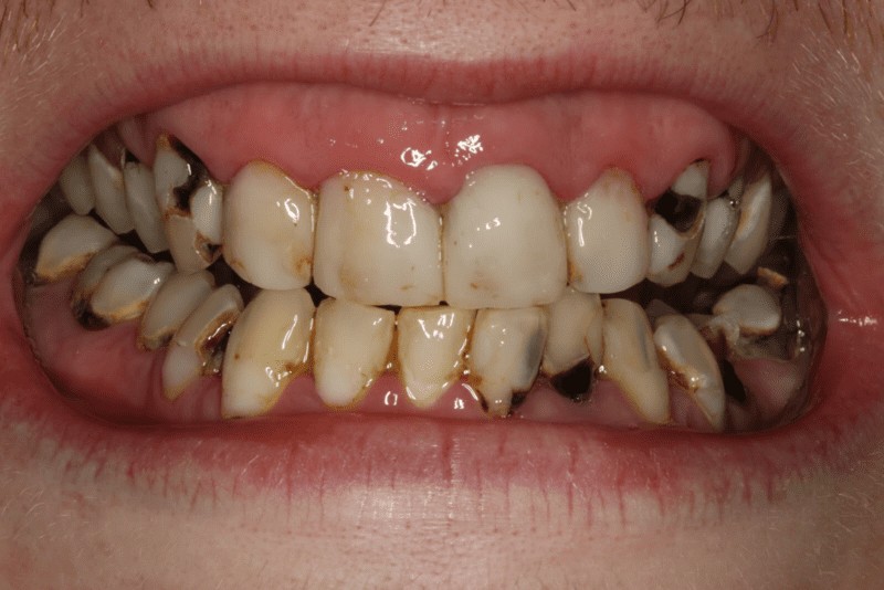 Chảy máu chân răng và miệng có mùi hôi cũng có thể do sâu răng