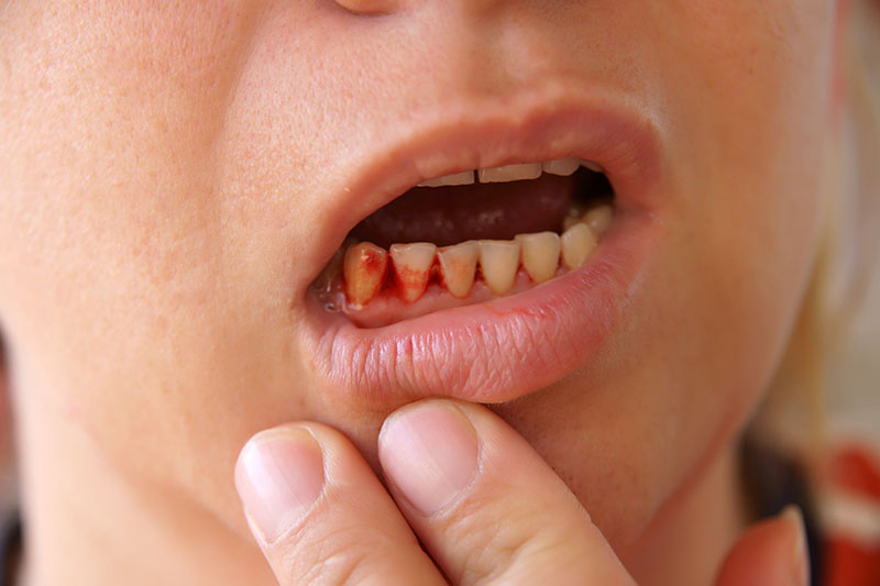 Chảy máu chân răng nên ăn gì để nhanh hồi phục là điều nhiều người bệnh quan tâm