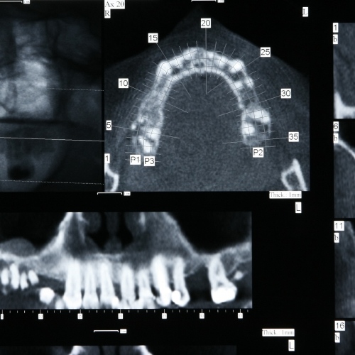 Chụp X-quang răng phục vụ việc chẩn đoán và điều trị nha khoa