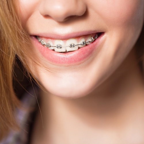 Niềng răng giúp chữa cười hở lợi hiệu quả nhưng thời gian thực hiện khá lâu