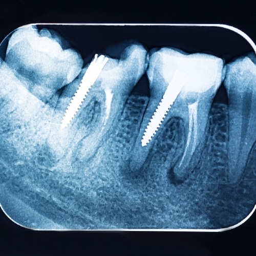 X-quang Periapical chụp tập trung một vị trí răng duy nhất