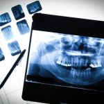 Chụp X-quang Răng: Phương Pháp, Quy Trình Và Một Vài Lưu Ý