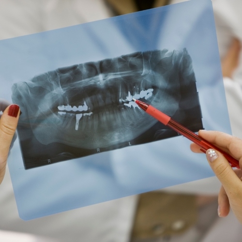 Chụp X-quang răng mang đến nhiều lợi ích trong điều trị nha khoa
