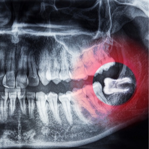 Lợi ích từ việc chụp X-quang răng khôn