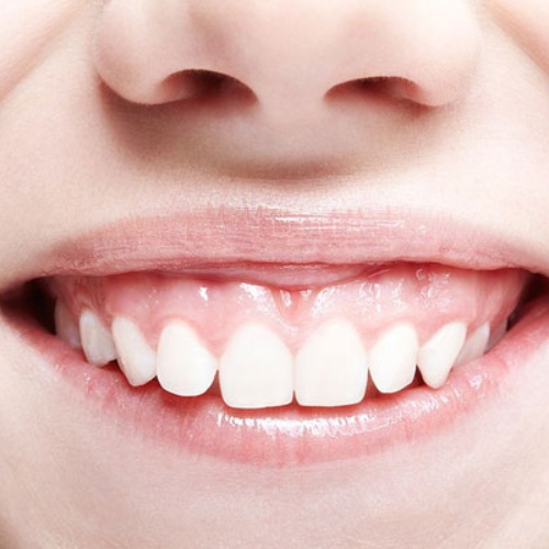 Cười hở lợi do sự phát triển bất thường của răng và xương hàm 