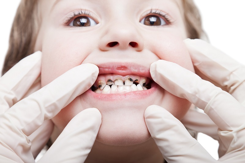 Dấu hiệu cảnh báo trẻ em 5 tuổi bị sâu răng