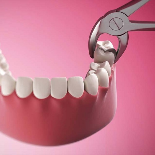 Nhiễn khuẩn do quá trình nhổ răng không đúng cách