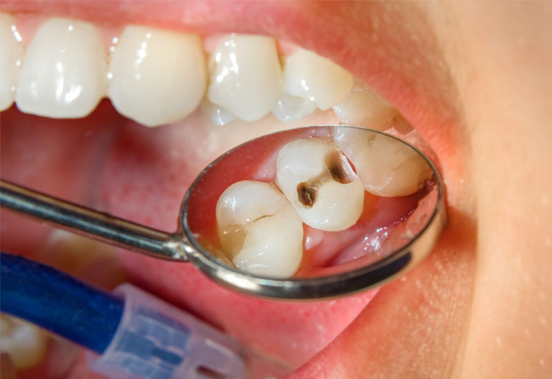 Sâu răng là nguyên nhân phổ biến nhất gây ra đau răng khi nhai thức ăn