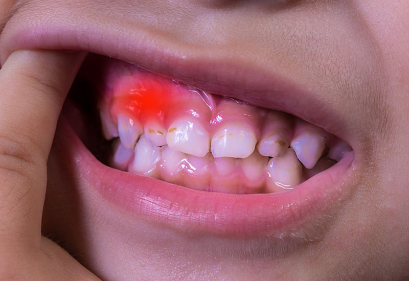 Các bệnh về nướu cũng là một nguyên nhân khiến răng bị đau nhức