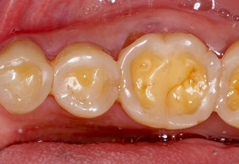 Răng bị mài mòn cũng dẫn đến đau răng khi nhai thức ăn