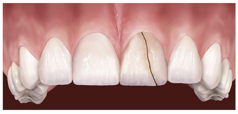 Răng bị nứt do tổn thương cũng là nguyên nhân gây ê buốt răng thường gặp