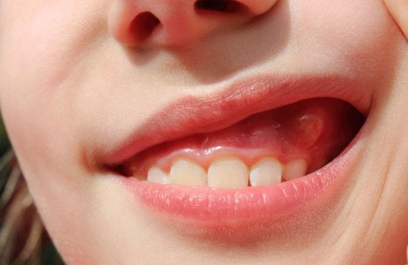 Răng bị áp xe cũng là một nguyên nhân gây đau nhức