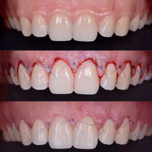 Phẫu thuật  tạo hình xương ổ răng - Chữa cười hở lợi 