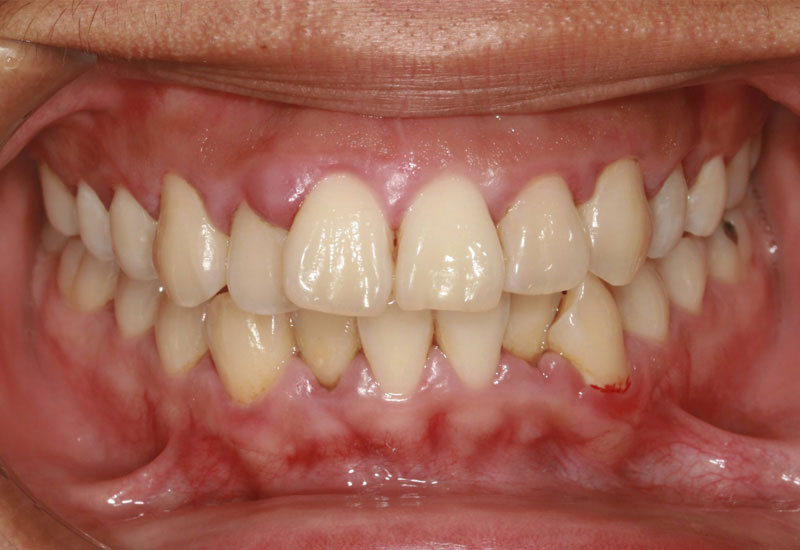 Viêm nướu răng là tình trạng sưng tấy, viêm nhiễm ở khu vực nướu răng gây đau nhức, khó chịu, có thể gặp ở mọi độ tuổi