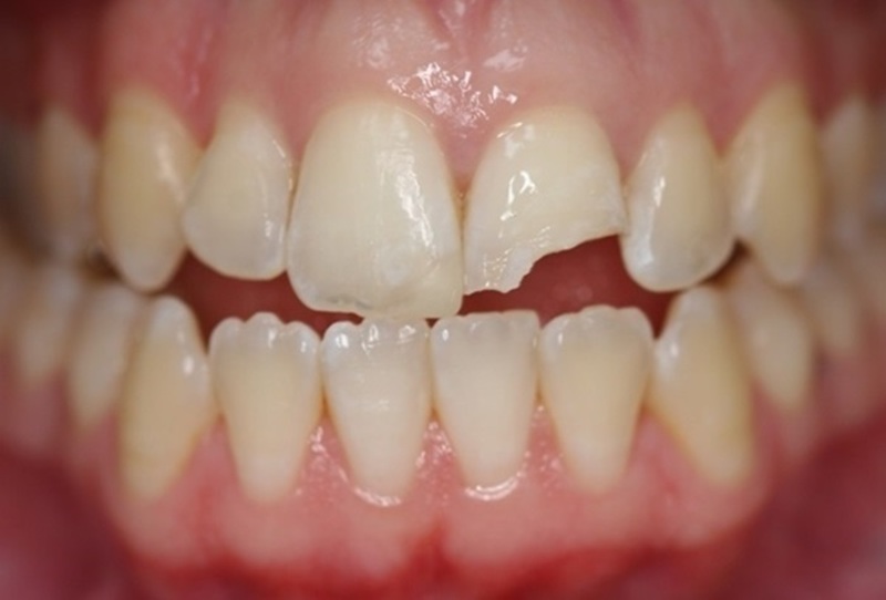 Một trong những nguyên nhân gây ê buốt chính là người bệnh bị vỡ răng