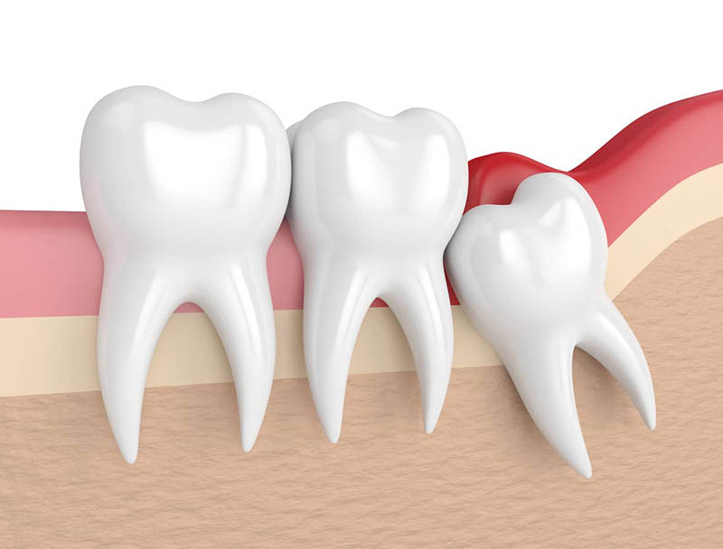 Răng không không được điều trị kịp thời gây nhiều ảnh hưởng xấu đến sức khoẻ