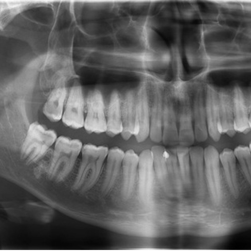 Răng khôn mọc thẳng bình thường bác sĩ không khuyến nghị nhổ