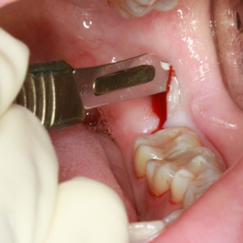 Nhổ răng khôn chỉ được tiến hành trong một số trường hợp nhất định