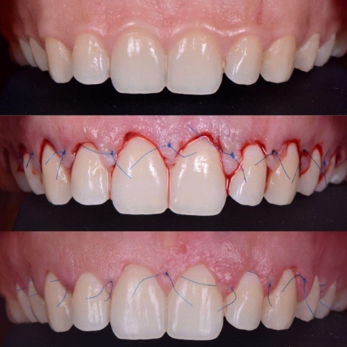 Phẫu thuật làm dài thân răng phù hợp cho những đối tượng bị cười hở lợi 