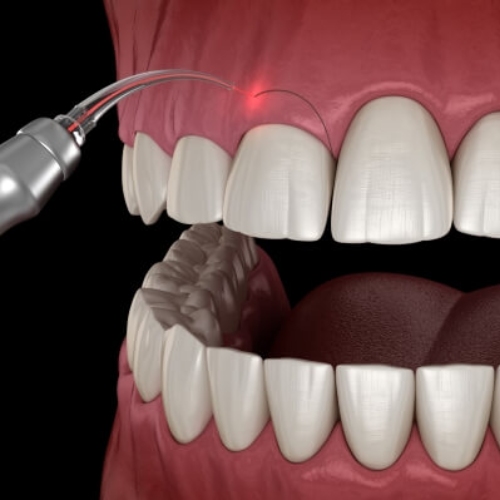 Phẫu thuật làm dài thân răng bằng tia laser Picasso 7.0