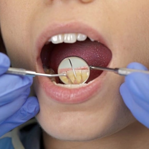 Lấy cao răng bị tụt lợi do bác sĩ thao tác quá mạnh