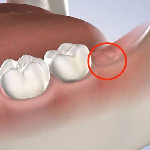 Hầu hết các ca nhổ răng khôn đều để lại lỗ sau phẫu thuật